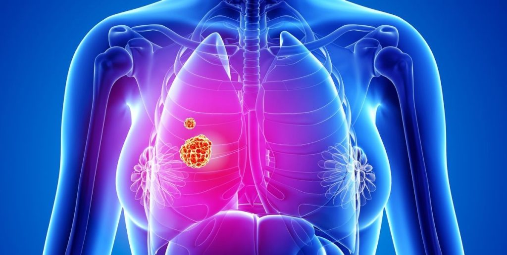 The early symptoms and signs of lung cancer