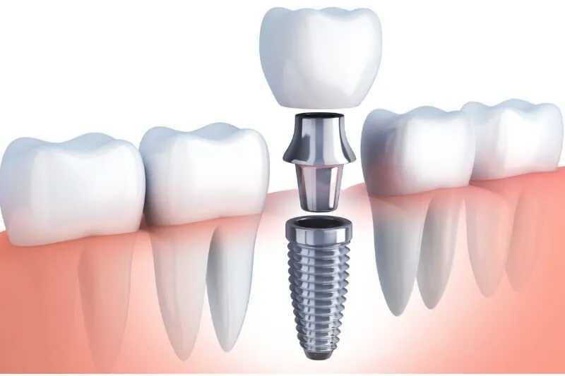 State-Of-The-Art Dental Implants for Missing Teeth Replacement