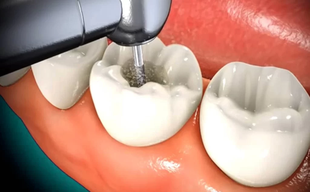 Major Consequences Of Delaying A Root Canal