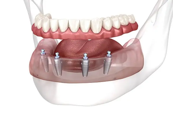 Bone Odyssey: Strengthening The Jaw Foundation For Implants
